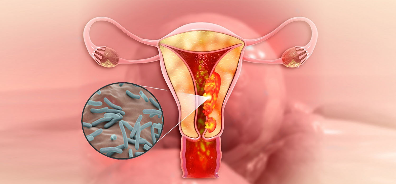 Female Genital Tuberculosis